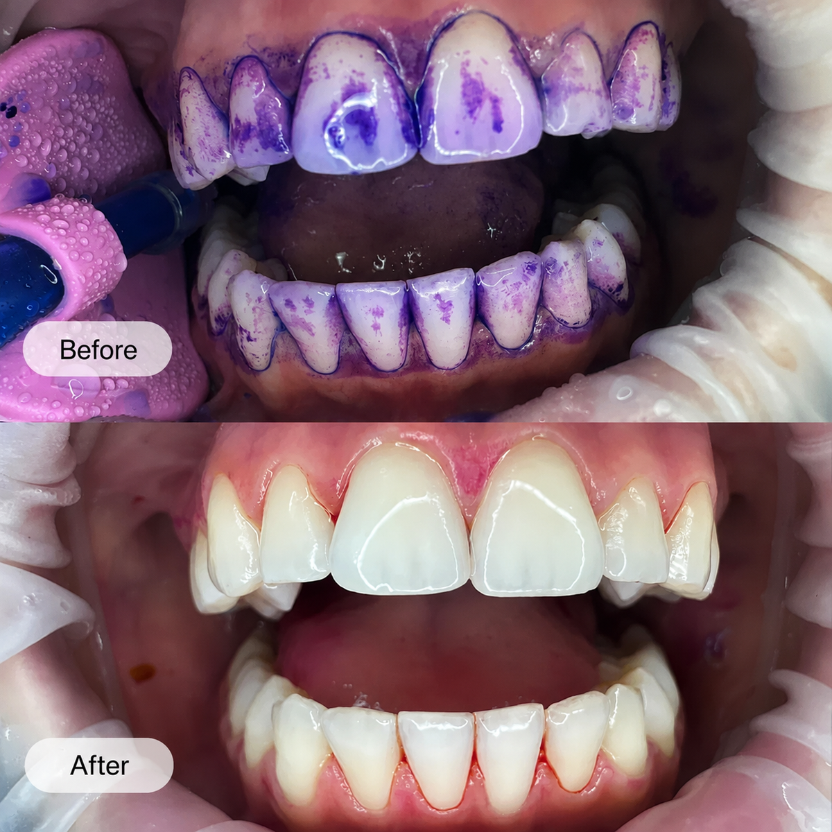 Dr. Dent: V34 Whitening Strips